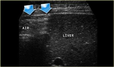 Siêu âm ở tư thế nằm nghiêng trái cho thấy khí tự do.