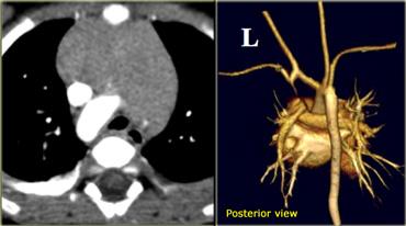 Axial image and volume rendering posterior view