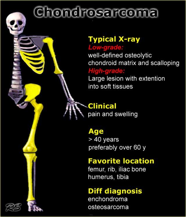 Low-grade chondrosarcoma