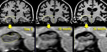 Coronal T1WI of the hippocampus  demonstrating progressive atrophy in familial AD (images kindly provided by Nick Fox).