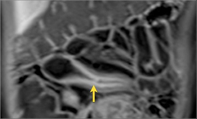 Mucosal enhancement pattern