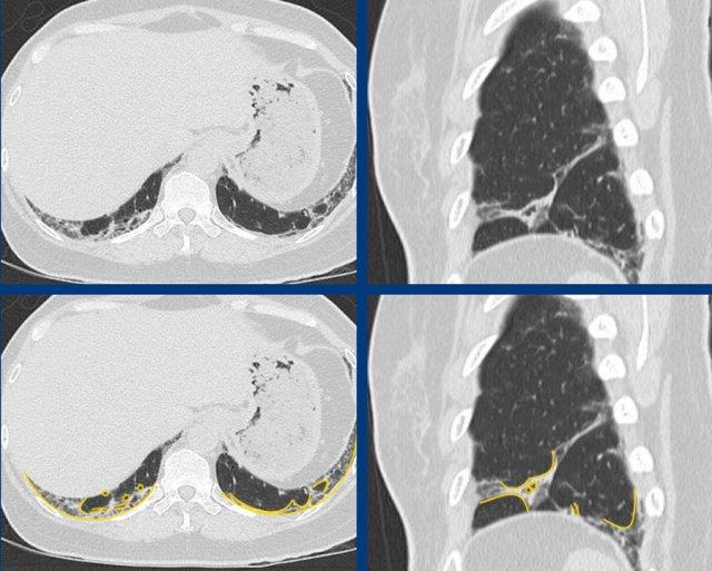 ibrotic NSIP in anti-synthetase syndrome