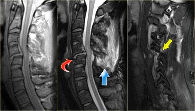 Unilateral interfacetal dislocation