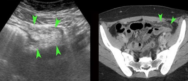 PID ở hố chậu trái