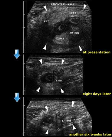 Quá trình thoái triển của đám quánh ruột thừa: Tại thời điểm nhập viện, tám ngày sau và cuối cùng là sáu tuần sau đó.