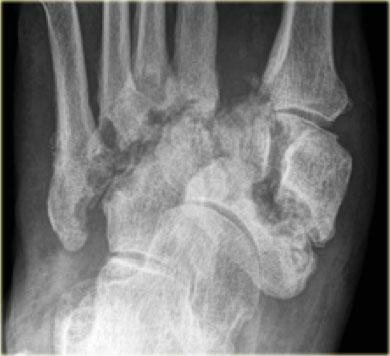 Chronic stage of Charcot osteoarthropathy