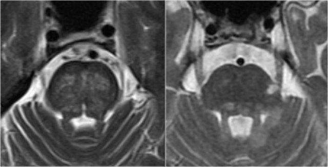 Symmetrical brainstem lesions in SVD (left) compared to typical asymmetrical MS lesions (right)