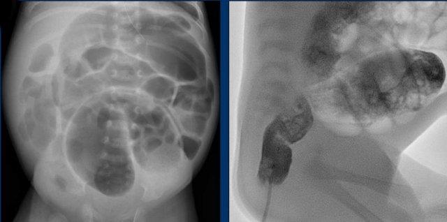 Typical case of Hirschsprung disease involving the rectum (short segment disease).