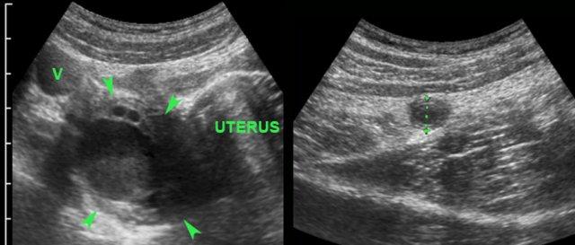 Acute appendicitis and right ovarian cyst. (v= iliac vein)
