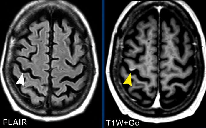 Ngấm thuốc dạng hồi não ở bệnh nhân nữ ung thư vú