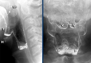 LEFT: Lateral view during singing aaa. Hyoid (H) and tongue base (T) move anteriorly. Left and right pyriform sinuses are projected on top of each other. Tip of soft palate (SP) is seen. RIGHT: Valleculae (V) and pyriform sinuses (P).