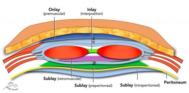 Examples of the many positions of meshes