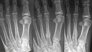 Gãy xương do stress xương bàn chân thứ 2: X-quang tại thời điểm khám và theo dõi sau 1 và 3 tháng.