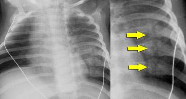 Old posterior rib fractures very indicative of non accidental trauma.