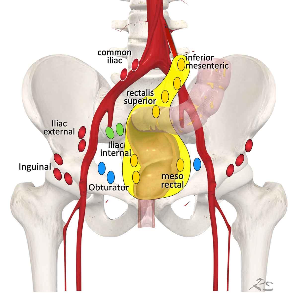 Regional lymph node drainage. The lymph nodes in red are all non, regional (M-stage) nodes. In TME only the mesorectal nodes and in high rectal tumors also the rectalis superior and inferior mesenteric nodes are excised.