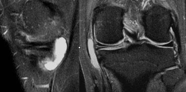 Horizontal tear with a meniscal cyst