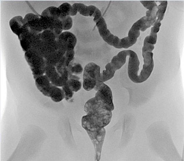 Microcolon: elongated colon with smalldiameter.  It indicates that meconium has not reached the colon yet. Once the obstruction is relieved and bowel contents pass through the colon, the colon will develop normally without remaining consequences.