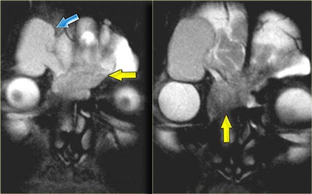 Mucocele (blue arrow) secondary to obstructing tumor (yellow arrow)