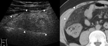 Hình 8. Nam giới 41 tuổi bị nhồi máu mạc nối. A, Siêu âm vùng bụng phải giữa cho thấy một vùng mỡ phúc mạc viêm rộng (đầu mũi tên). B, CT không tiêm thuốc cản quang mô tả tổn thương là một vùng mỡ mạc nối viêm dạng bánh (đầu mũi tên), lớn hơn so với viêm túi mỡ đại tràng và không có vòng tăng tỷ trọng.
