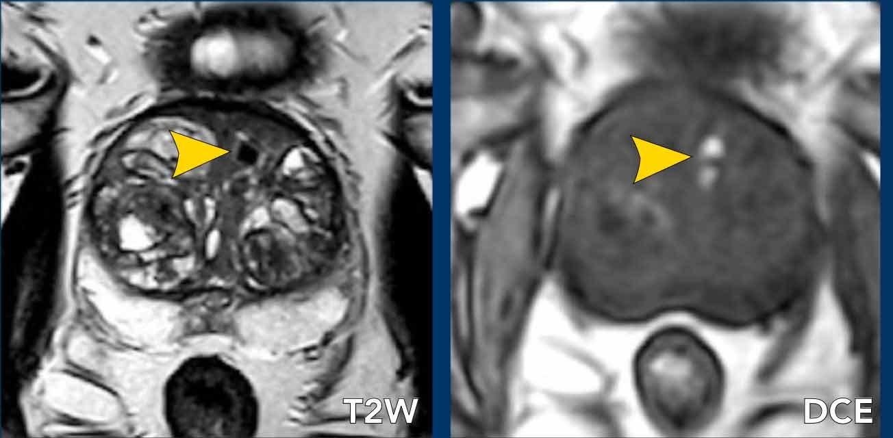 Chảy máu. Ảnh DCE được chụp trước khi ngấm thuốc tương phản từ.