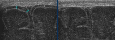 TRÁI: Khoang dưới nhện bình thường. PHẢI: Tránh đè ép lên thóp.