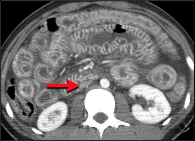 Shock bowel with hyperenhancement. Slit-like IVC (red arrow).