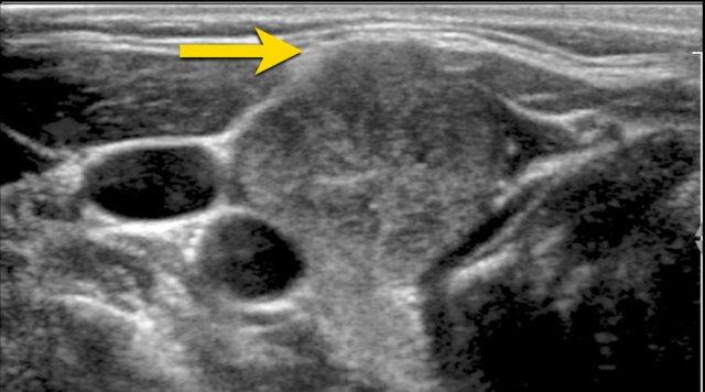 Exophytic growth but no frank invasion.