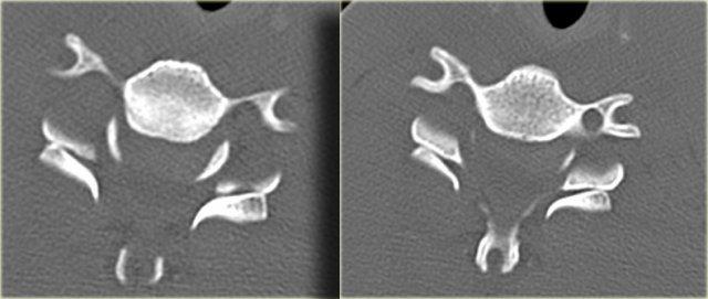 Double inverted hamburger sign in bilateral facetal dislocation