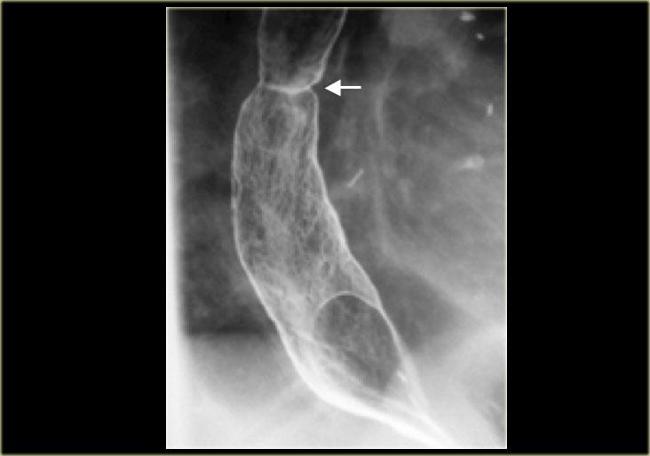 Barrett's esophagus with reticular mucosa and web-like (arrow) stricture