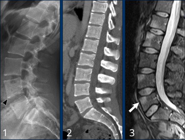 Early stage ankylosing spondylitis