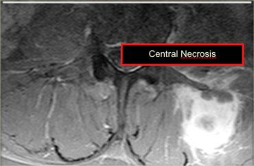 Metastasis of a renal cell carcinoma with central necrosis