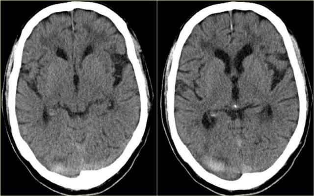 Khối máu tụ bắt chước dấu hiệu mạch máu tăng tỷ trọng