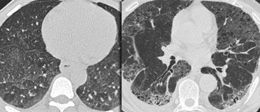 LEFT: No fibrosis, so potentially treatable lung disease. RIGHT: Fibrosis, so no treatable lung disease.