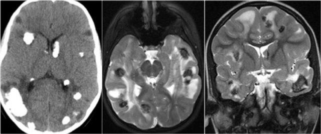 Xơ cứng củ - hình ảnh được cung cấp bởi Tạp chí Thần kinh X-quang Hoa Kỳ (American Journal of Neuroradiology).