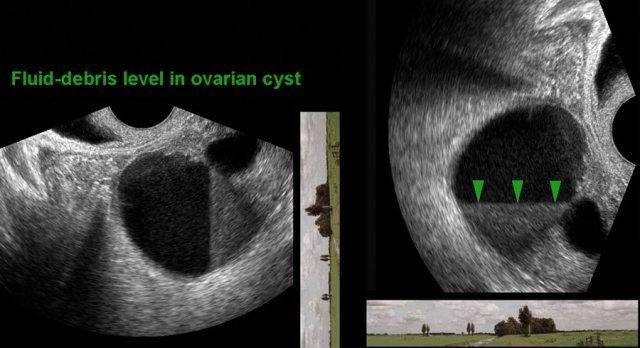 Fluid-debris-level in endometriotic cyst