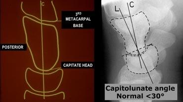 TRÁI: Trục xương đầuPHẢI: Phim X-quang với trục xương nguyệt và xương đầu được vẽ.