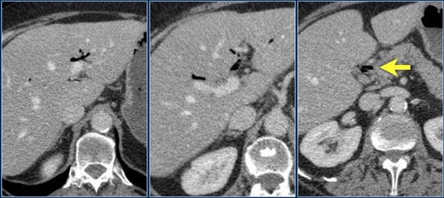 Pneumobilia: air in the intrahepatic bile ducts and in the common bile duct (arrow).