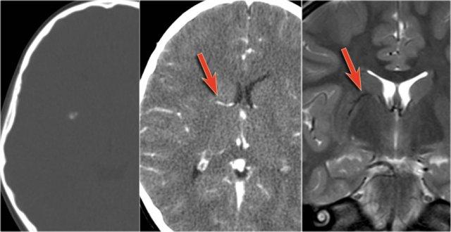 Cavernoma with associated DVA (arrow).