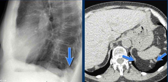 Thoát vị Bochdalek