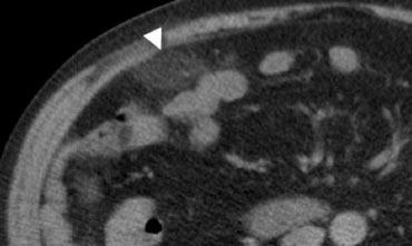 Hình 9. Nữ giới 47 tuổi với đau hố chậu phải cấp tính. CT không tiêm thuốc cản quang cho thấy một khối mỡ viêm hình bầu dục (đầu mũi tên) với các quai ruột lân cận bình thường. Hình dạng và kích thước của tổn thương gợi ý viêm túi mỡ đại tràng, nhưng tổn thương không chứa vòng tăng tỷ trọng. Trong trường hợp này, khó phân biệt giữa viêm túi mỡ đại tràng hay nhồi máu mạc nối nhỏ.