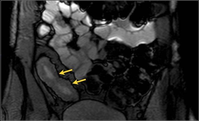 Balanced FFE image shows marked bowel wall thickening and luminal narrowing of the terminal ileum. Measurement on the balanced FFE sequence can be less accurate due to the black border artifact (arrows).