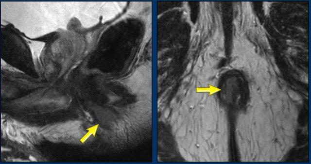 Khối u hậu môn ở 1/3 giữa và 1/3 dưới ống hậu môn trước điều trị.