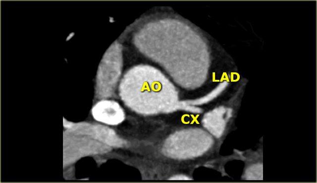 LCA phân chia thành LAD và Cx