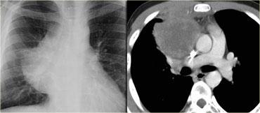 Dấu hiệu chồng rốn phổi: các mạch máu rốn phổi vẫn nhìn thấy được qua khối trung thất