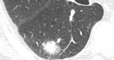 Nốt bán đặc chứa thành phần kính mờ có khả năng ác tính cao nhất