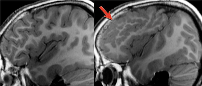 TRÁI: bình thường PHẢI: đa tiểu hồi não (mũi tên)