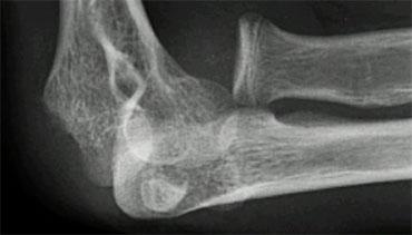 Dislocation of the elbow with interposed medial epicondyle.