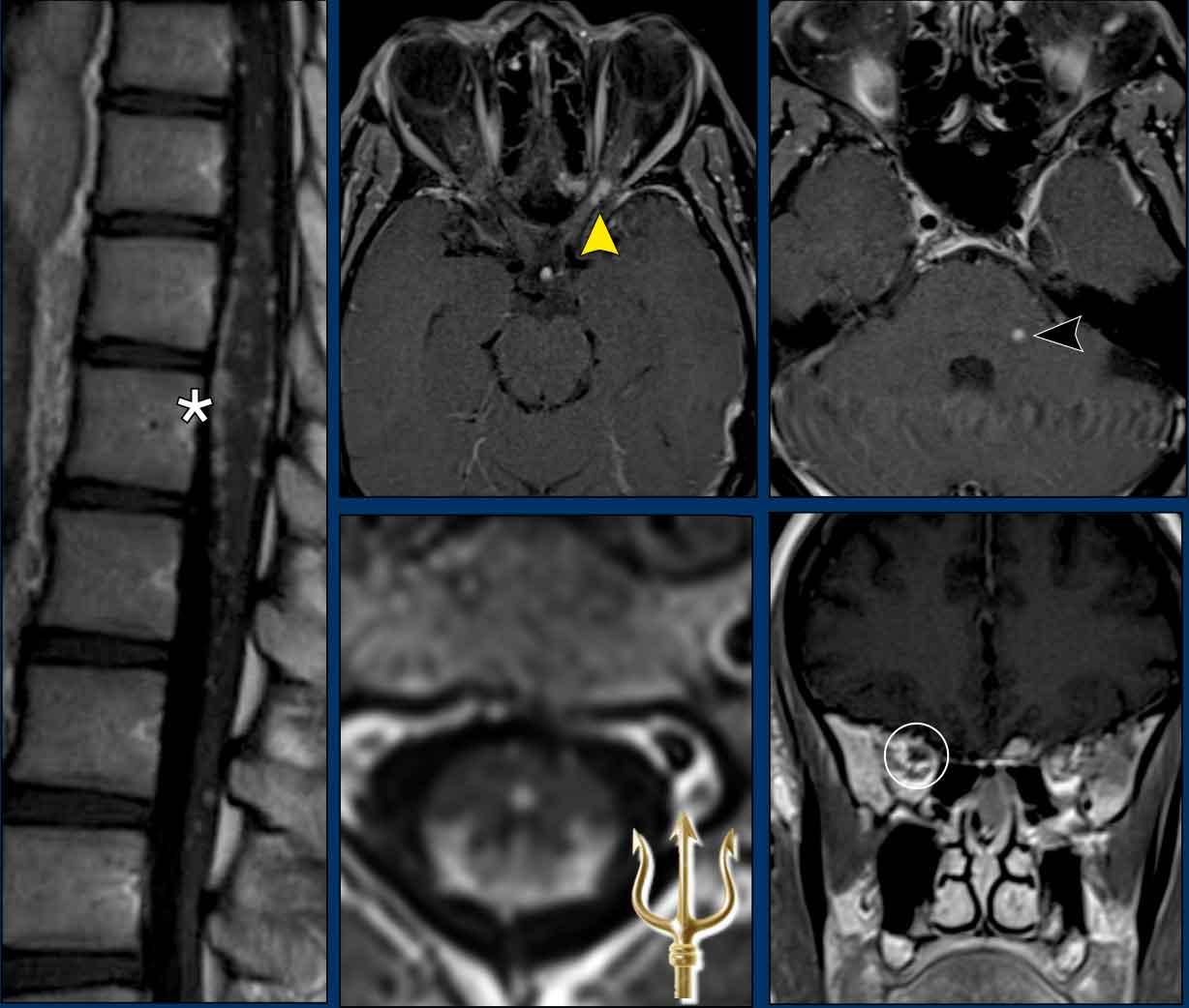 'Trident' sign in a patient with spinal neurosarcoidosis