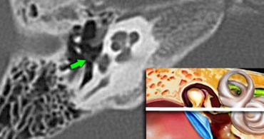 Xương bàn đạp (mũi tên xanh lá) được thấy kết nối với cửa sổ bầu dục.