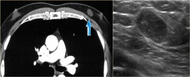 Myofibroblastoma eccentric to the nipple in a patient with a little bit of gynecomastia bilaterally